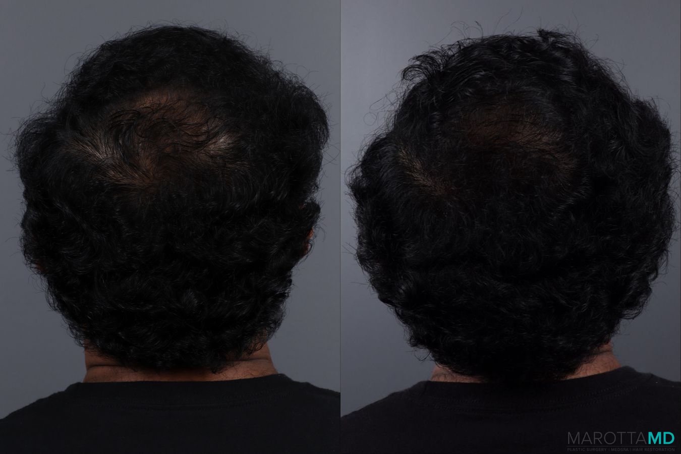 Before and after Hair Growth Serum case 17187