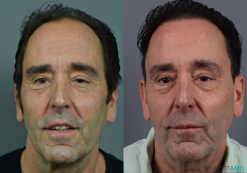 Hair Transplantation - Thumbnail 4