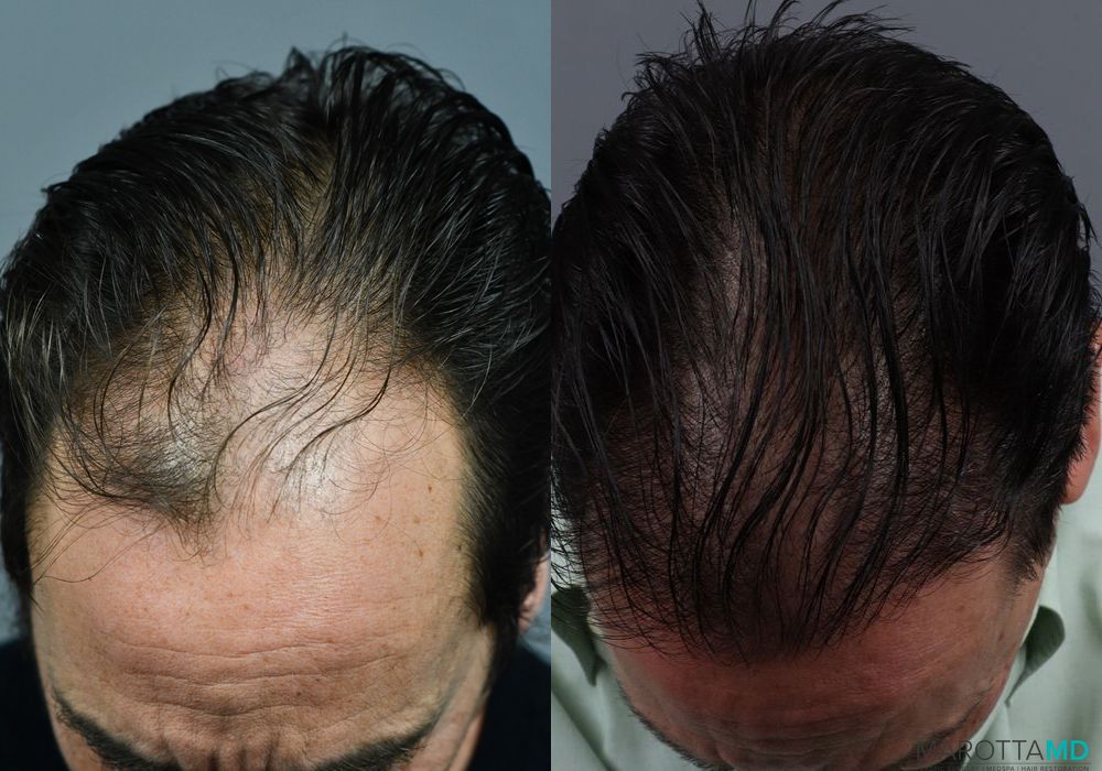 Hair Transplantation - Thumbnail 3