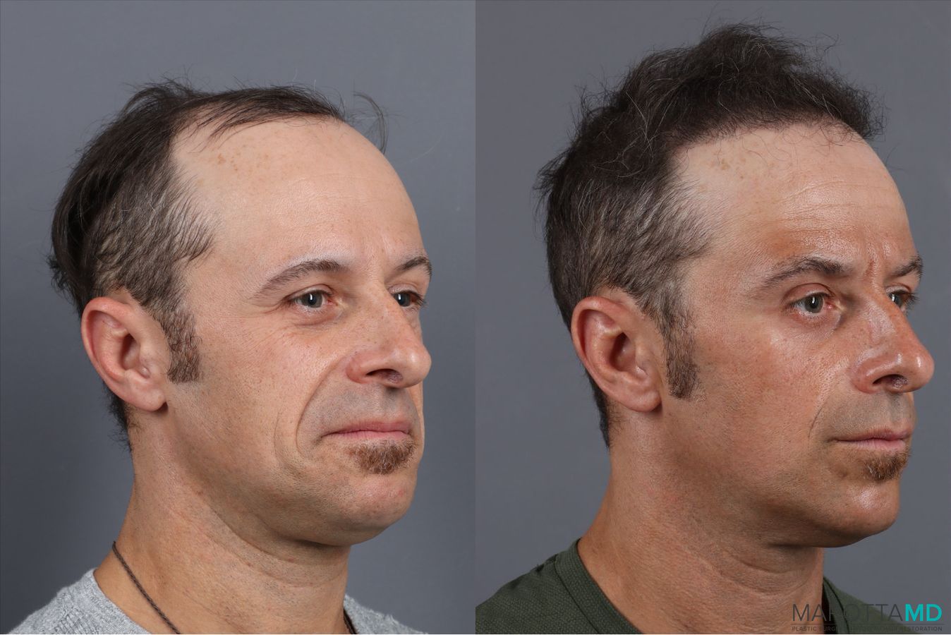 Before and after PRP Scalp Treatment case 41865 - Angle 2