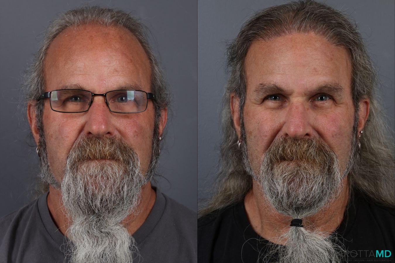 Before and after Hair Transplantation case 13186