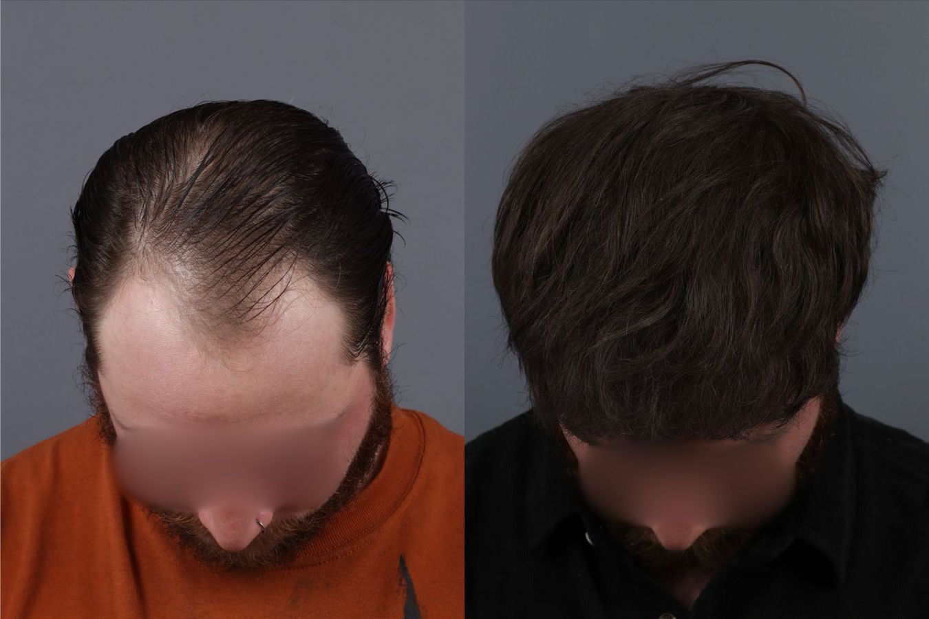 Before and after Hair Transplantation case 26095