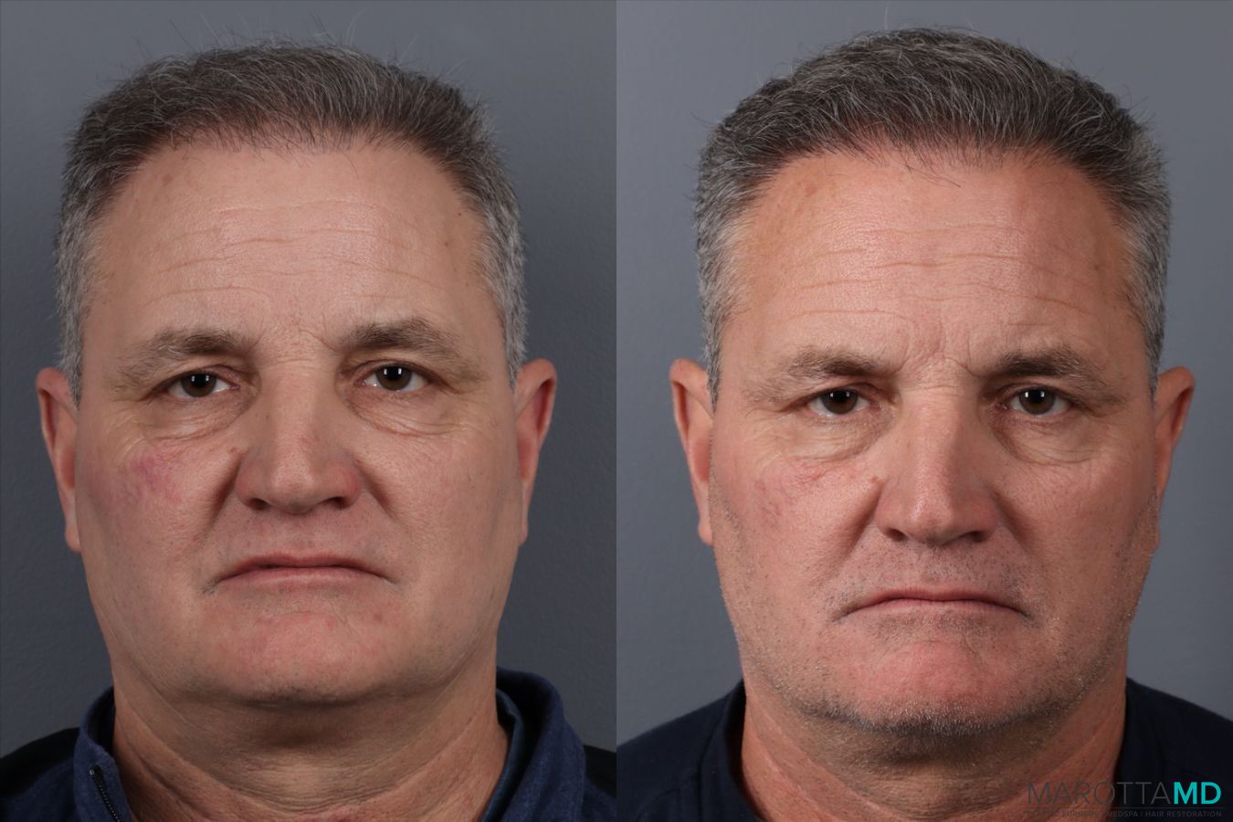 Before and after Hair Transplantation case 21381 - Angle 3