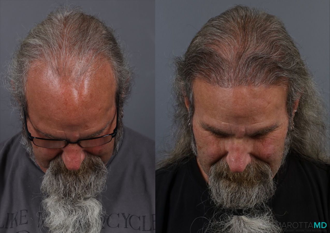 Before and after Hair Transplantation case 13186 - Angle 2