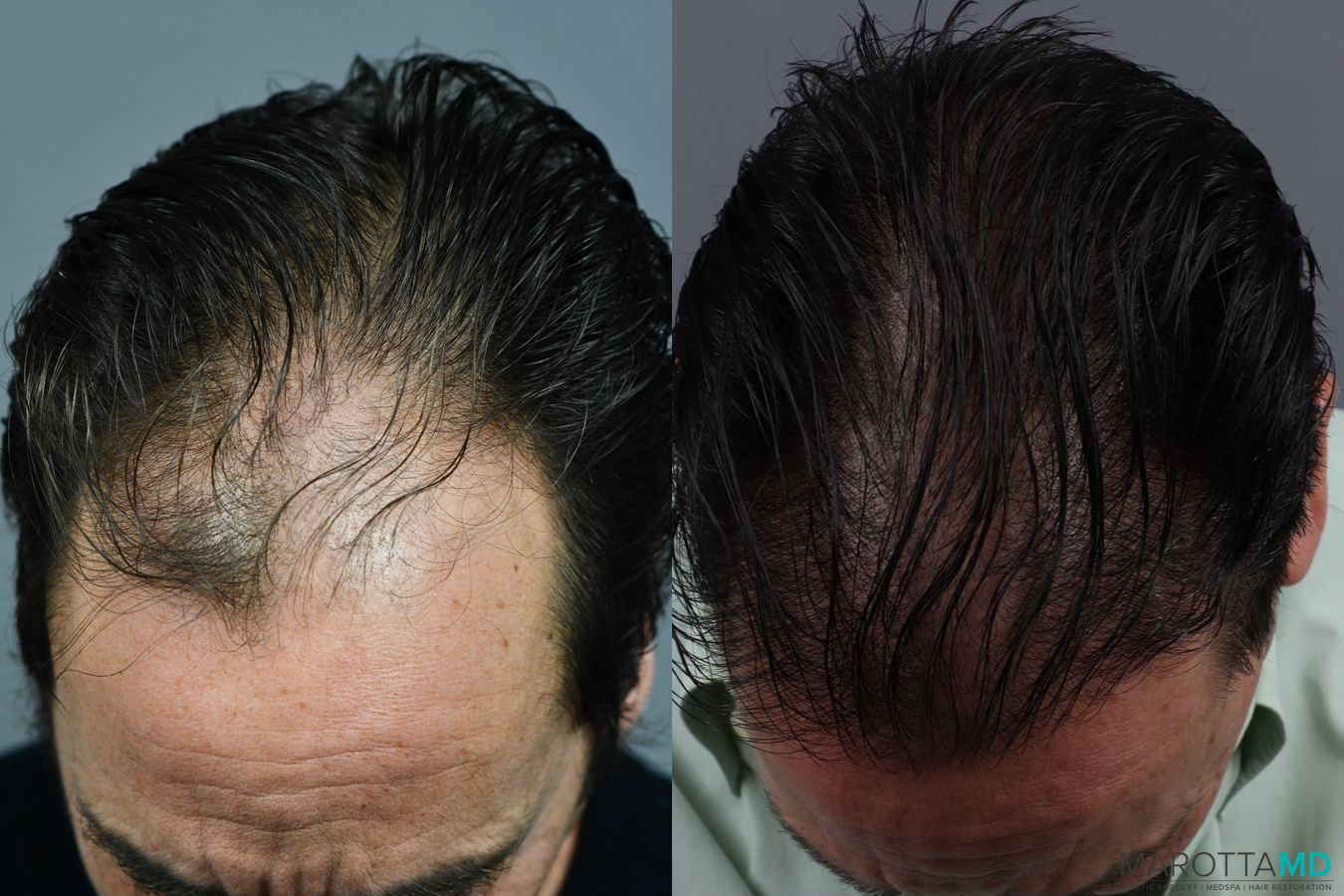 Before and after Hair Transplantation case 13569 - Angle 4