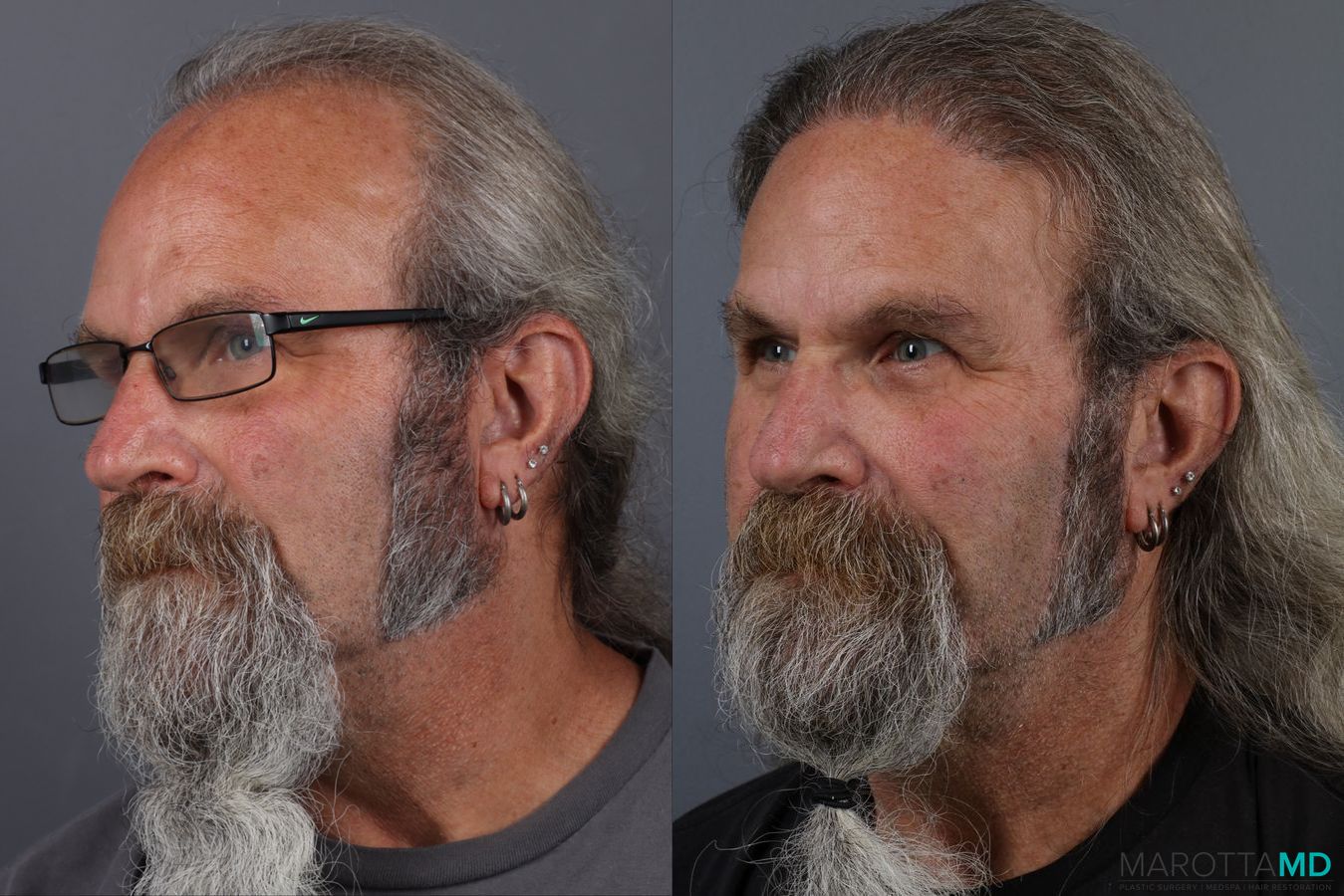 Before and after Hair Transplantation case 13186 - Angle 5