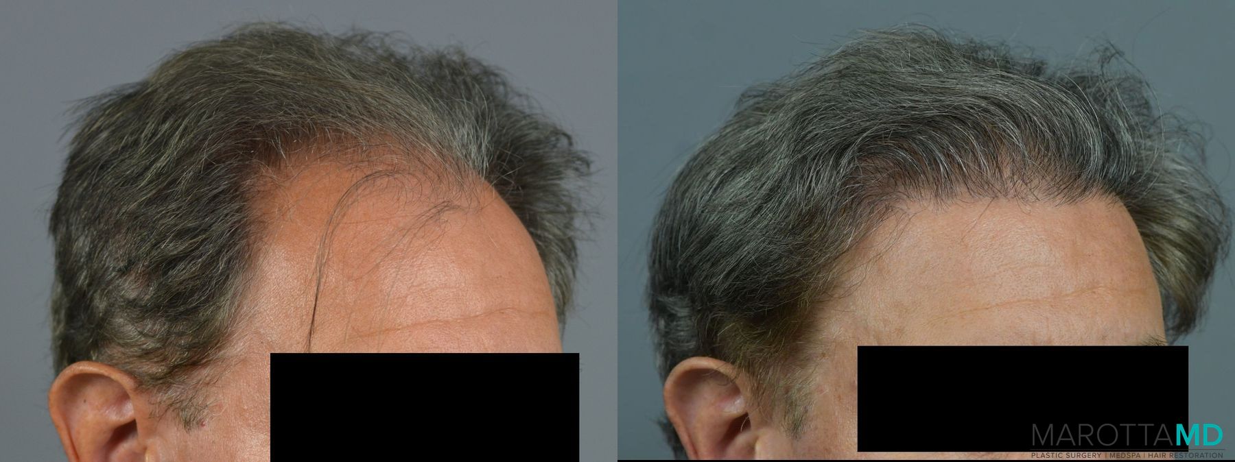 Before and after Hair Transplantation case 7048 - Angle 2