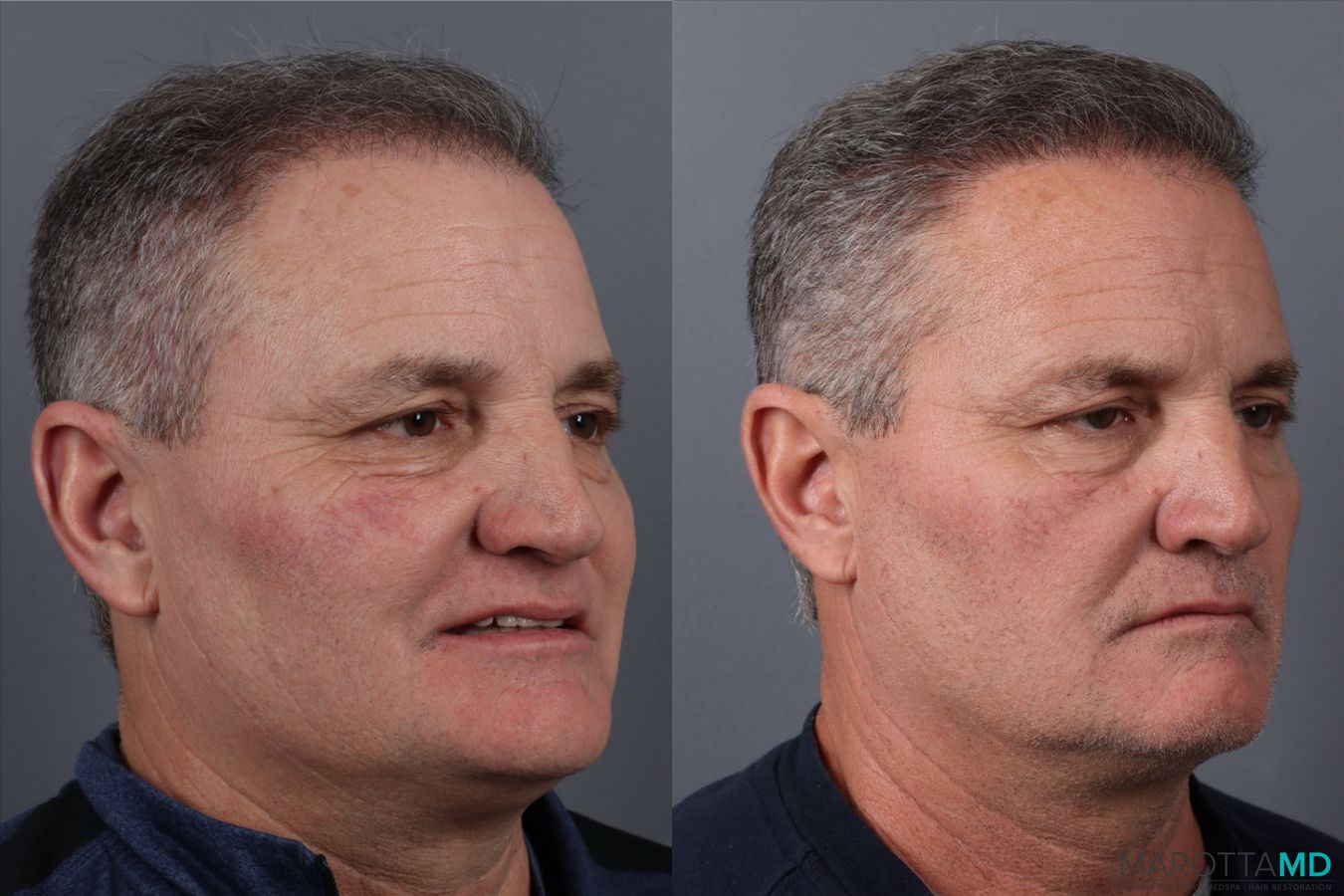 Before and after Hair Transplantation case 21381