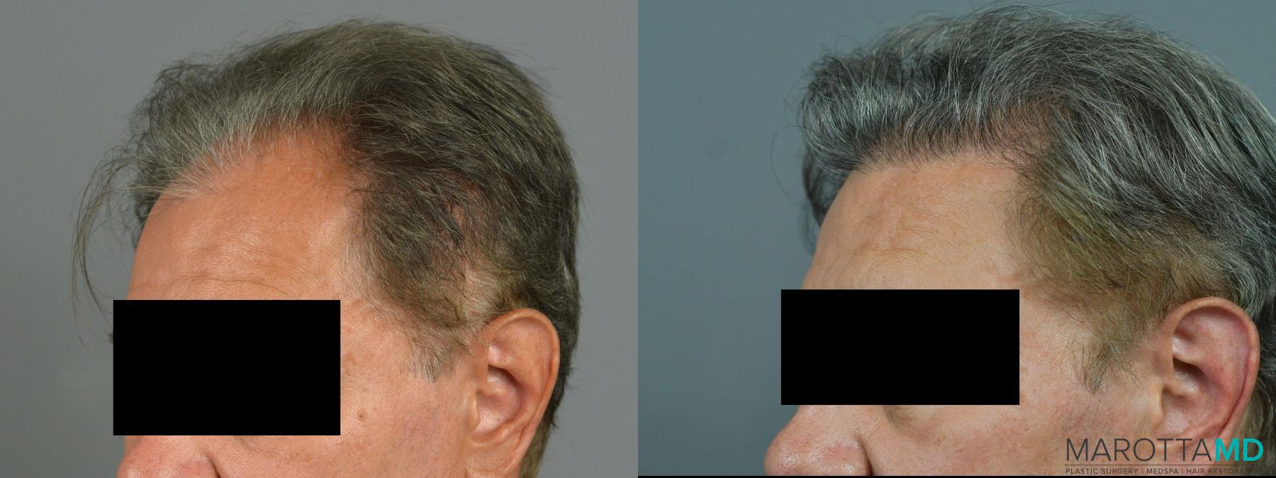 Before and after Hair Transplantation case 7048 - Angle 3