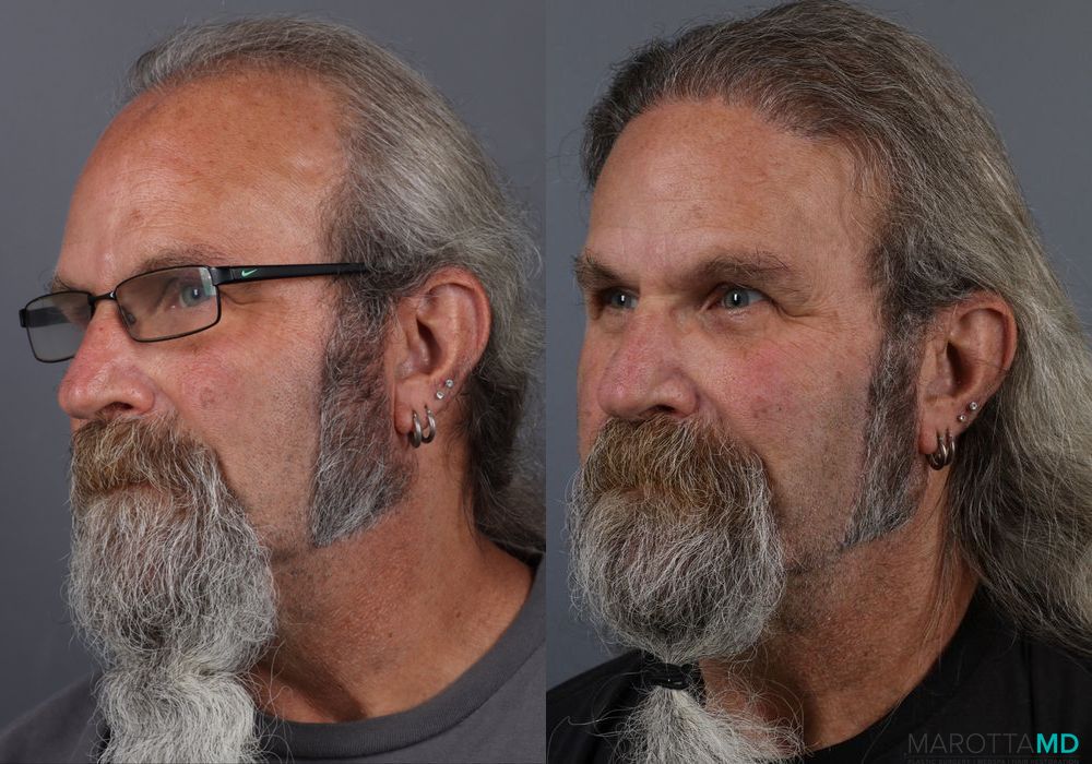 Hair Transplantation - Thumbnail 2