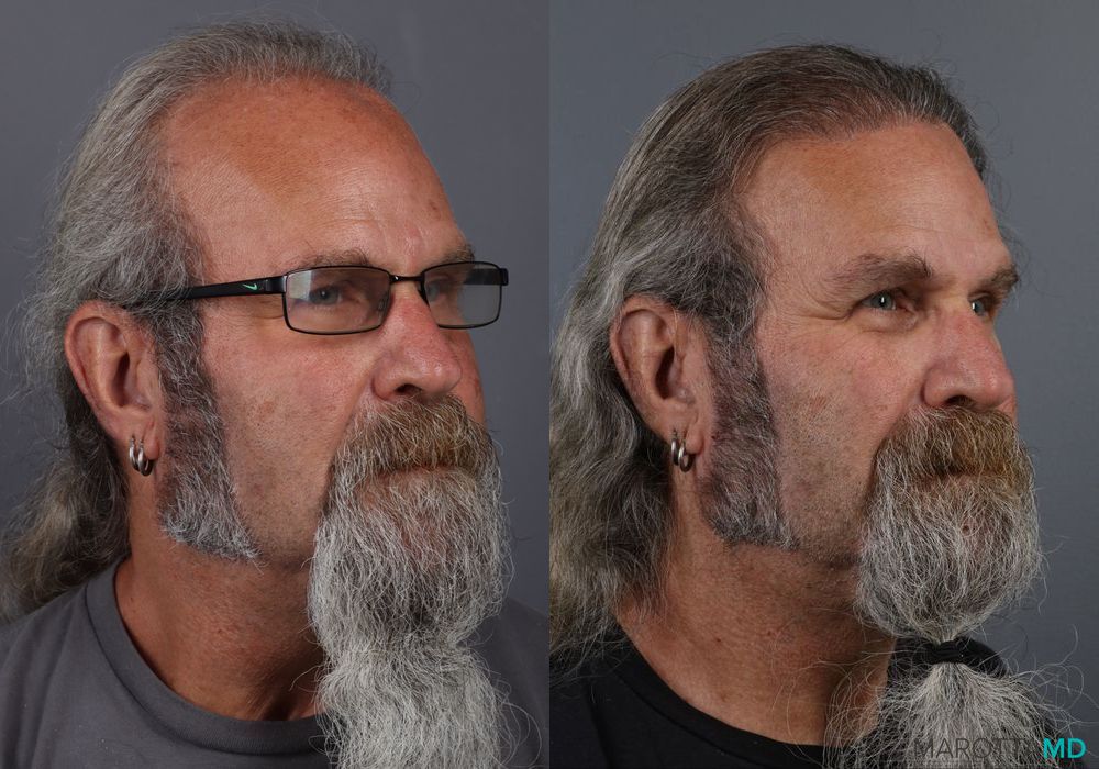 Hair Transplantation - Thumbnail 4