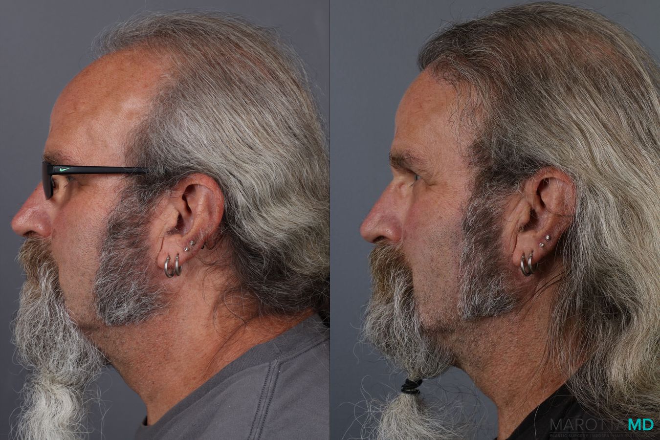 Before and after Hair Transplantation case 13186 - Angle 6