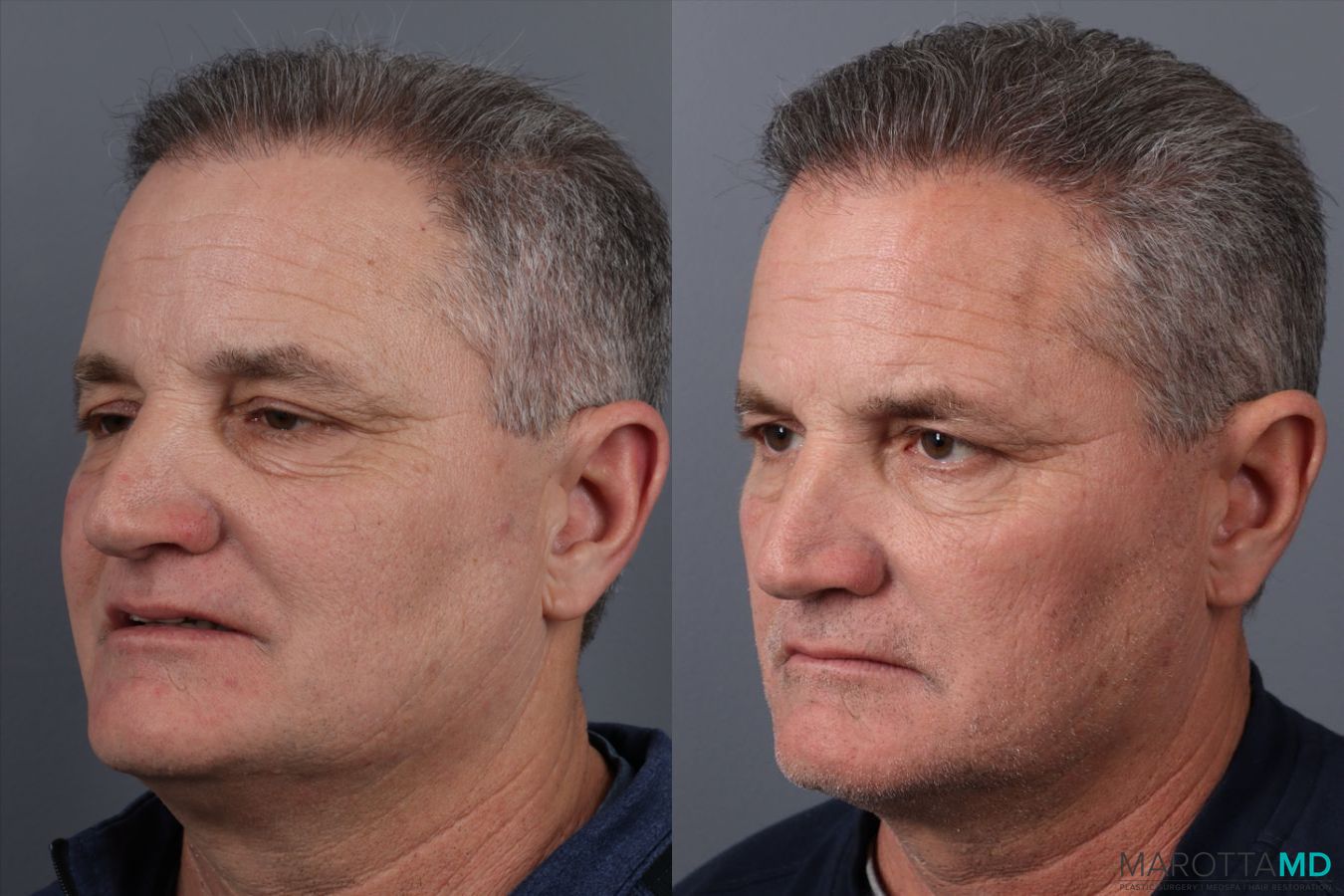 Before and after Hair Transplantation case 21381 - Angle 2
