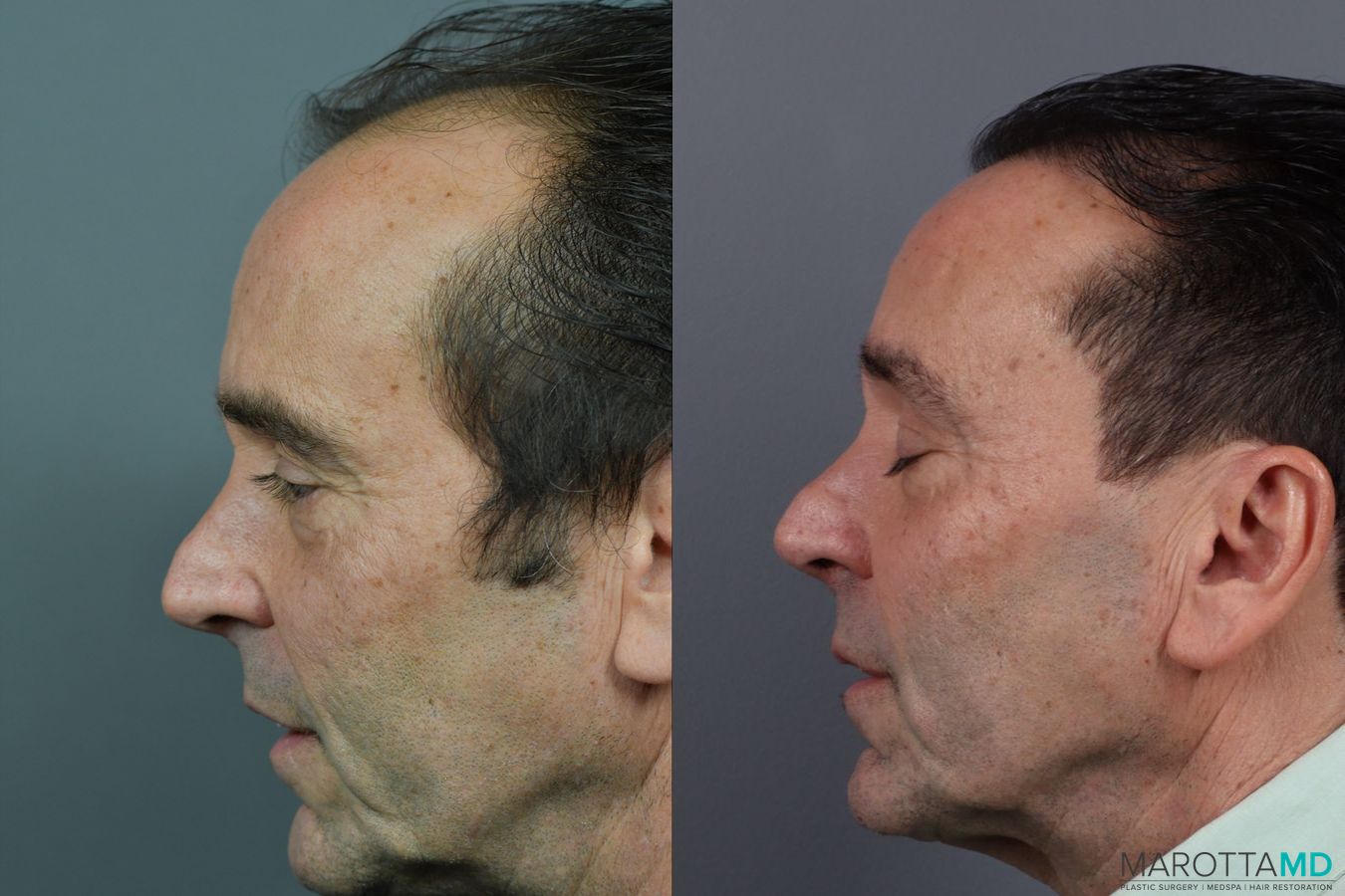 Before and after Hair Transplantation case 13569 - Angle 3
