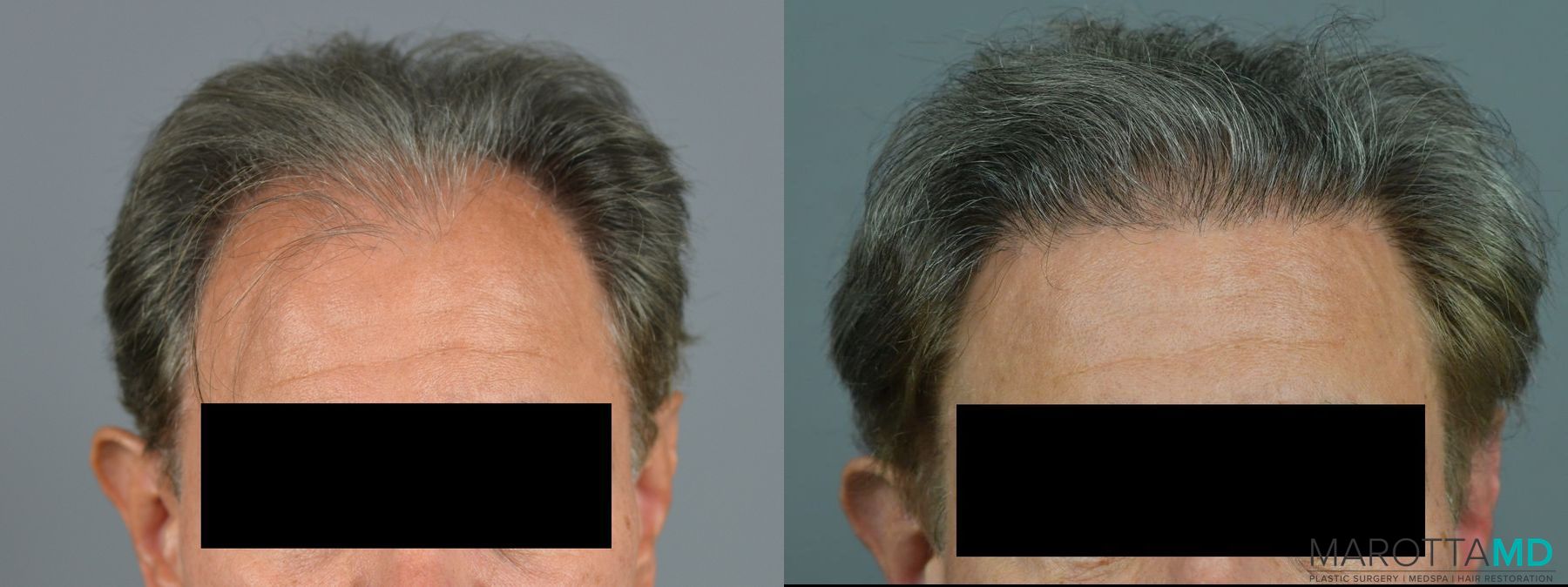 Before and after Hair Transplantation case 7048