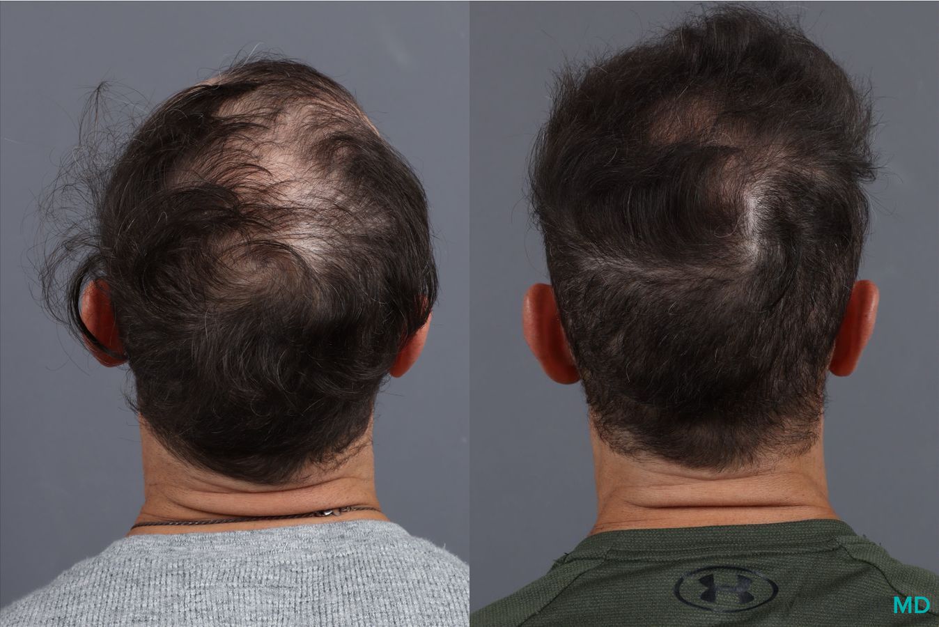 Before and after PRP Scalp Treatment case 41865 - Angle 4