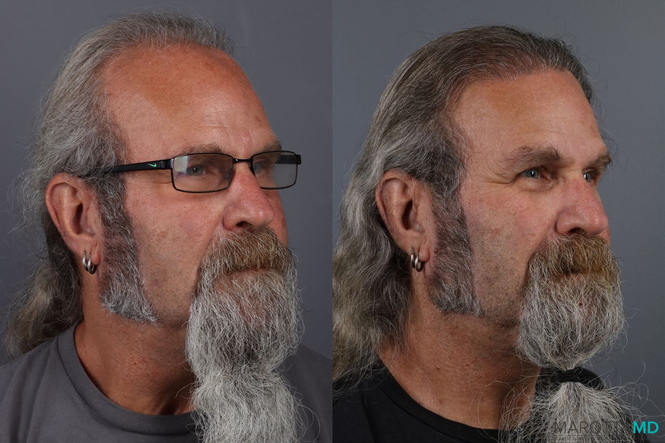 Before and after Hair Transplantation case 13186 - Angle 3