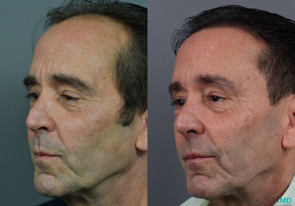 Hair Transplantation - Case 643