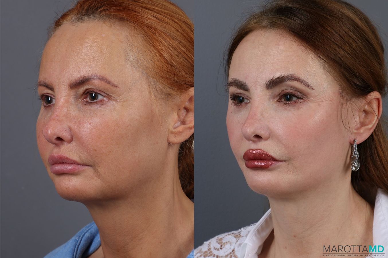 Before and after Hair Transplantation case 7076 - Angle 4