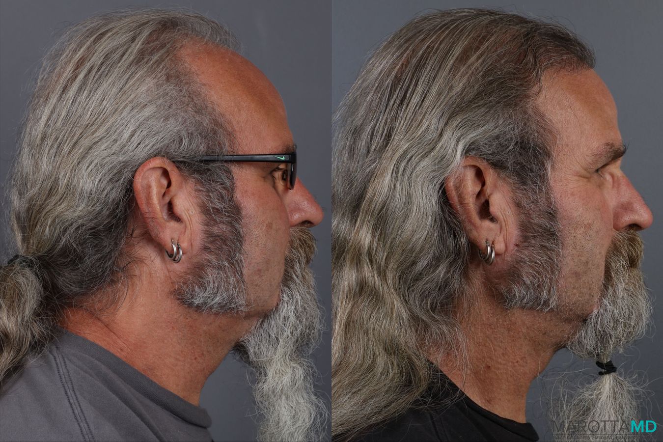 Before and after Hair Transplantation case 13186 - Angle 4