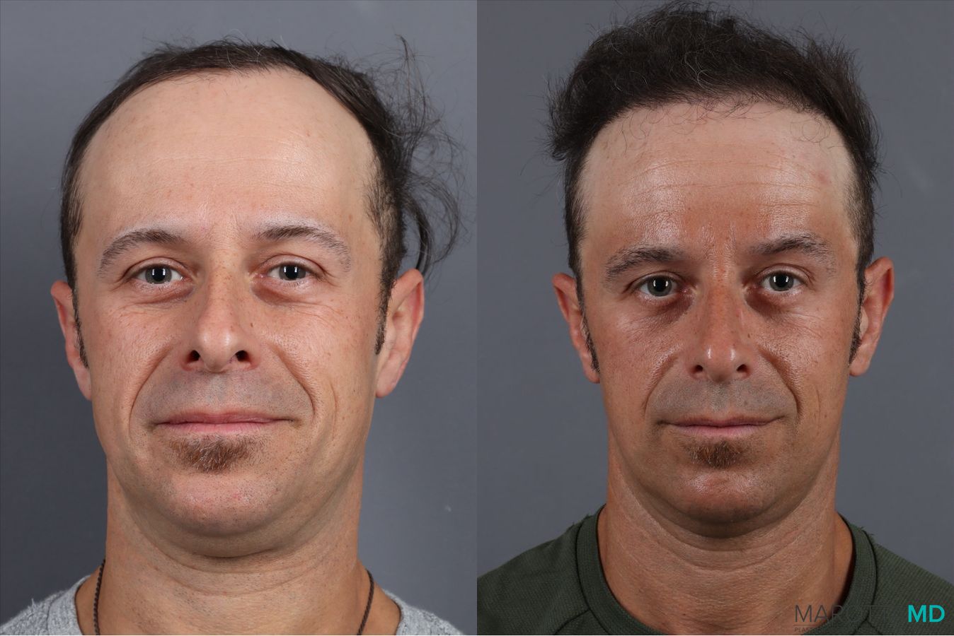 Before and after PRP Scalp Treatment case 41865