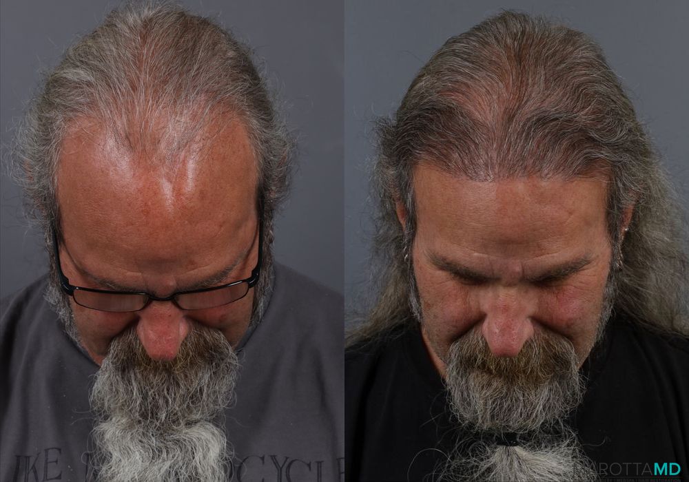 Hair Transplantation - Case 284