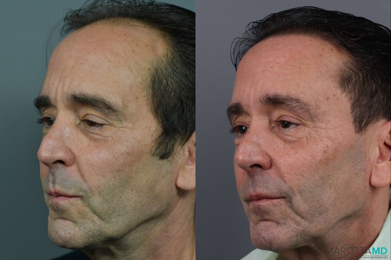 Before and after Hair Transplantation case 13569 - Angle 2