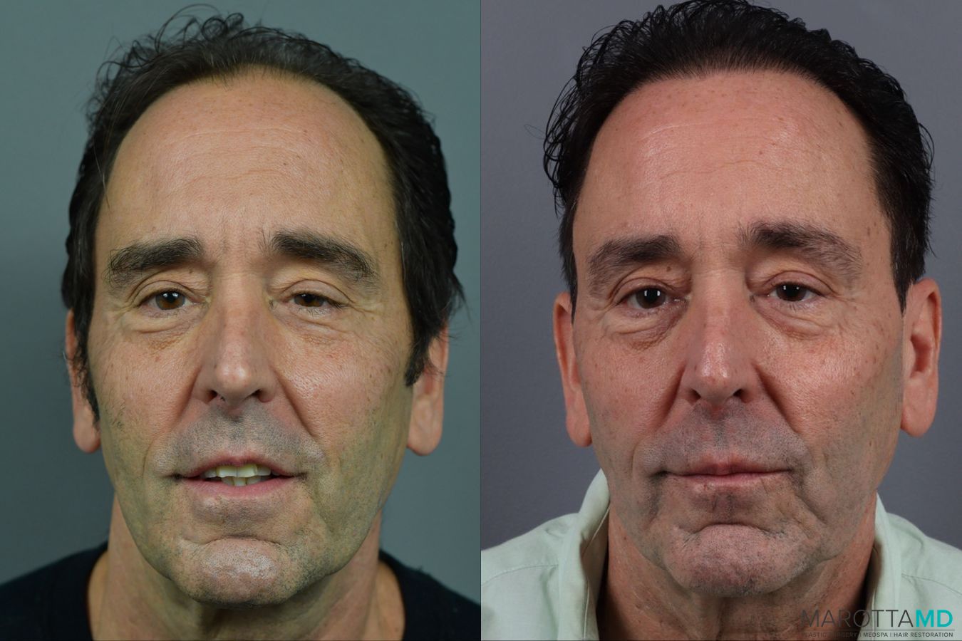 Before and after Hair Transplantation case 13569