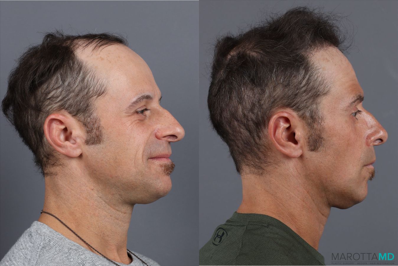 Before and after PRP Scalp Treatment case 41865 - Angle 3