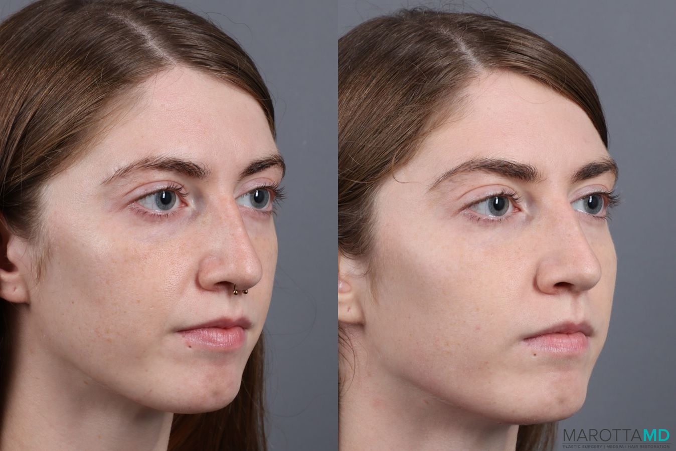Before and after Juvederm / Fillers case 7269 - Angle 3