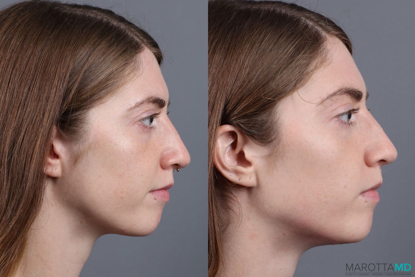 Before and after Juvederm / Fillers case 7269 - Angle 5