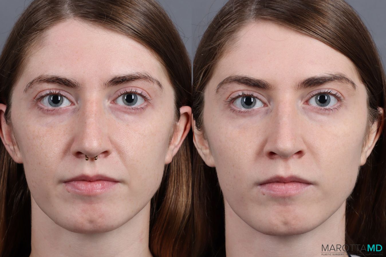 Before and after Juvederm / Fillers case 7269
