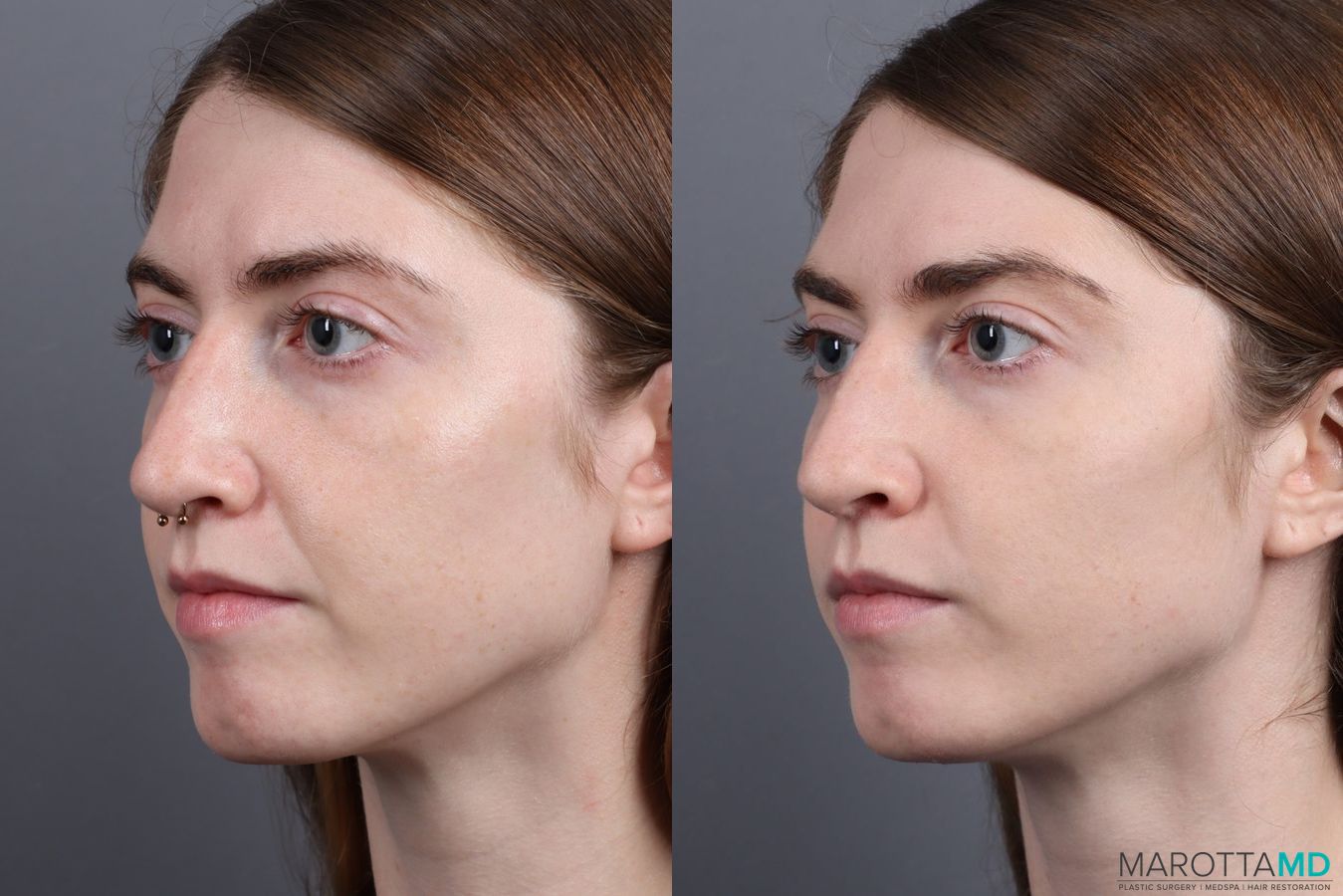 Before and after Juvederm / Fillers case 7269 - Angle 2