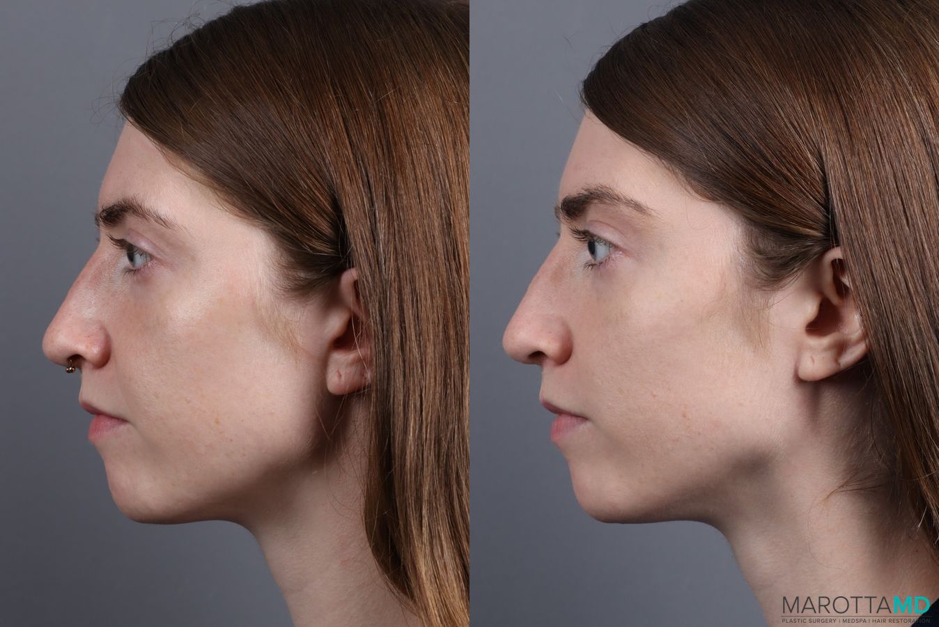 Before and after Juvederm / Fillers case 7269 - Angle 4