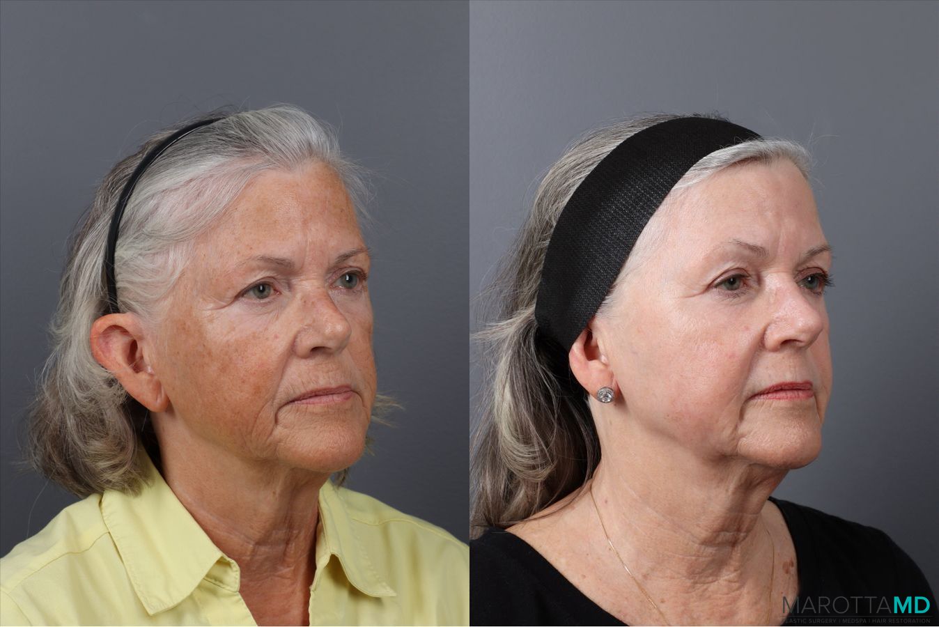 Before and after Laser Skin Resurfacing case 41763 - Angle 2