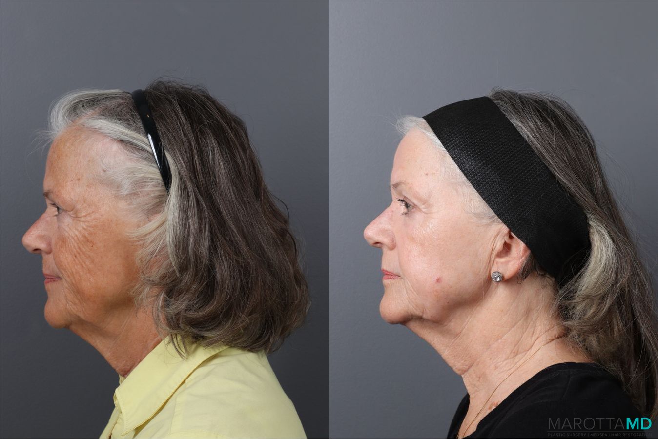 Before and after Laser Skin Resurfacing case 41763 - Angle 5