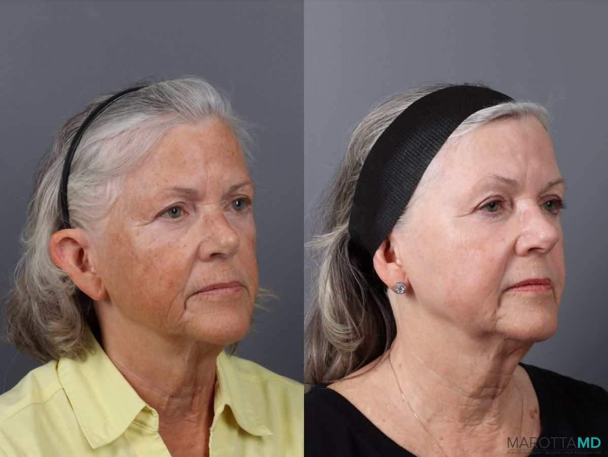 Before and after Laser Skin Resurfacing case 41763 - Angle 2
