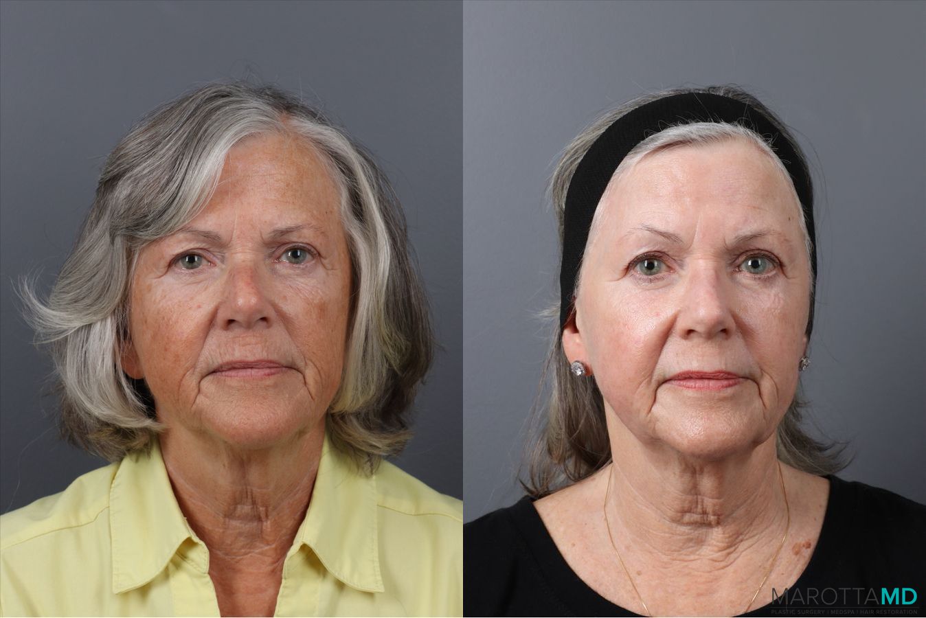 Before and after Laser Skin Resurfacing case 41763