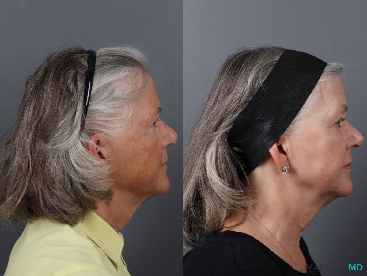 Before and after Laser Skin Resurfacing case 41763 - Angle 3