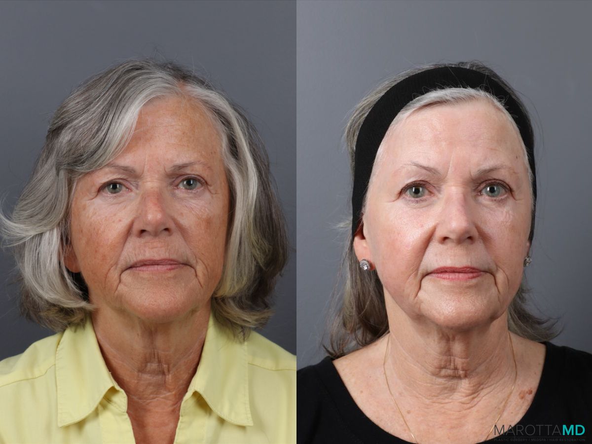 Before and after Laser Skin Resurfacing case 41763