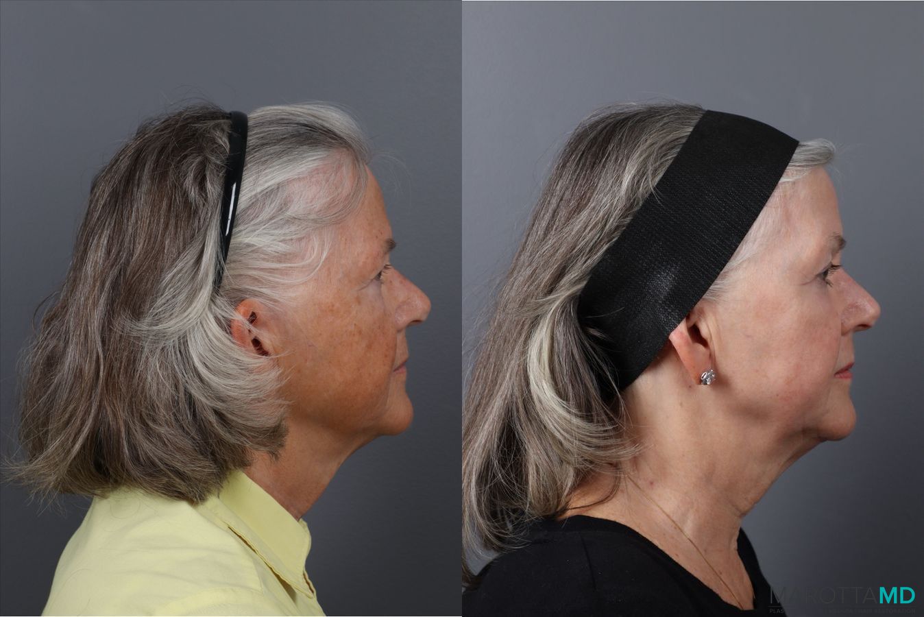 Before and after Laser Skin Resurfacing case 41763 - Angle 3