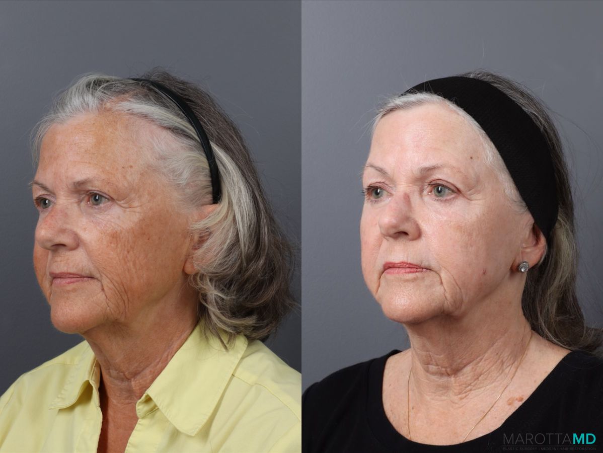 Before and after Laser Skin Resurfacing case 41763 - Angle 4