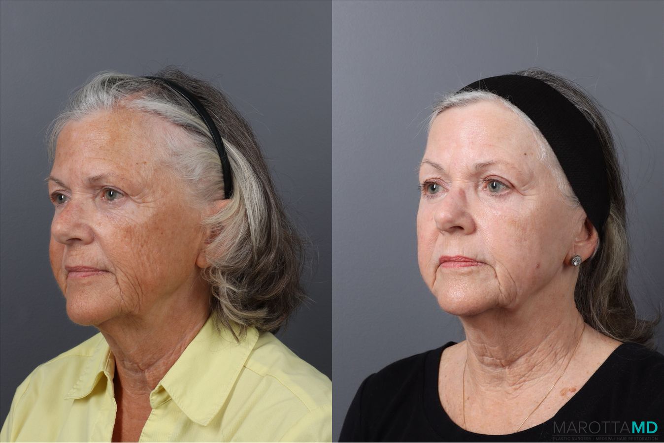 Before and after Laser Skin Resurfacing case 41763 - Angle 4