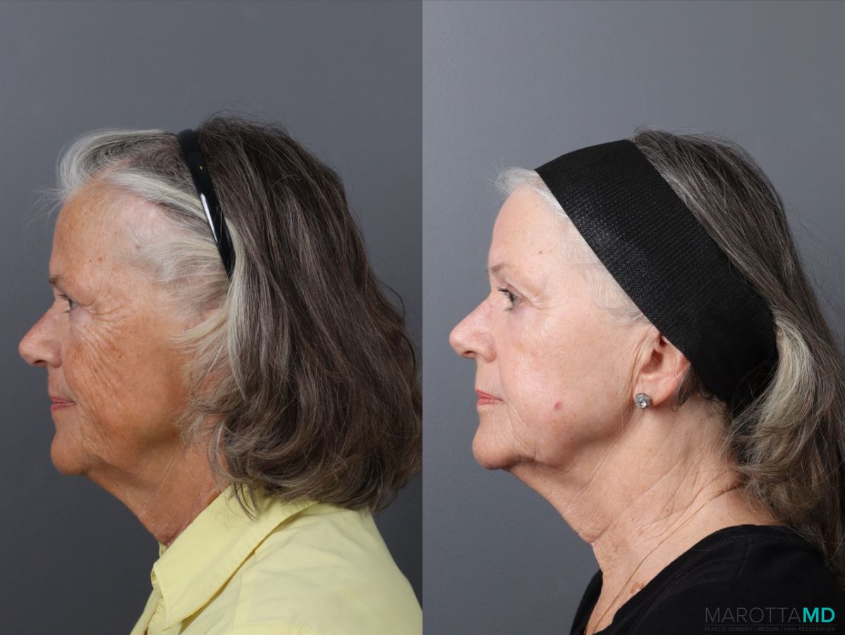 Before and after Laser Skin Resurfacing case 41763 - Angle 5
