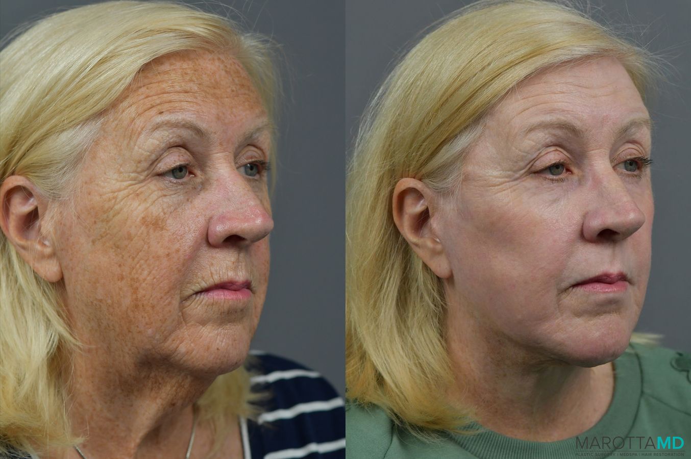 Before and after Laser Skin Resurfacing - Face case 7021 - Angle 4