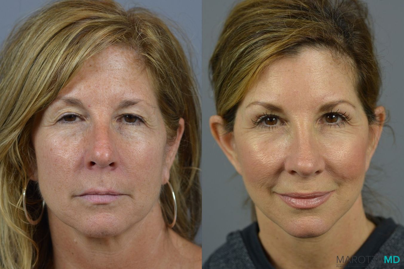 Before and after Laser Skin Resurfacing - Face case 7046