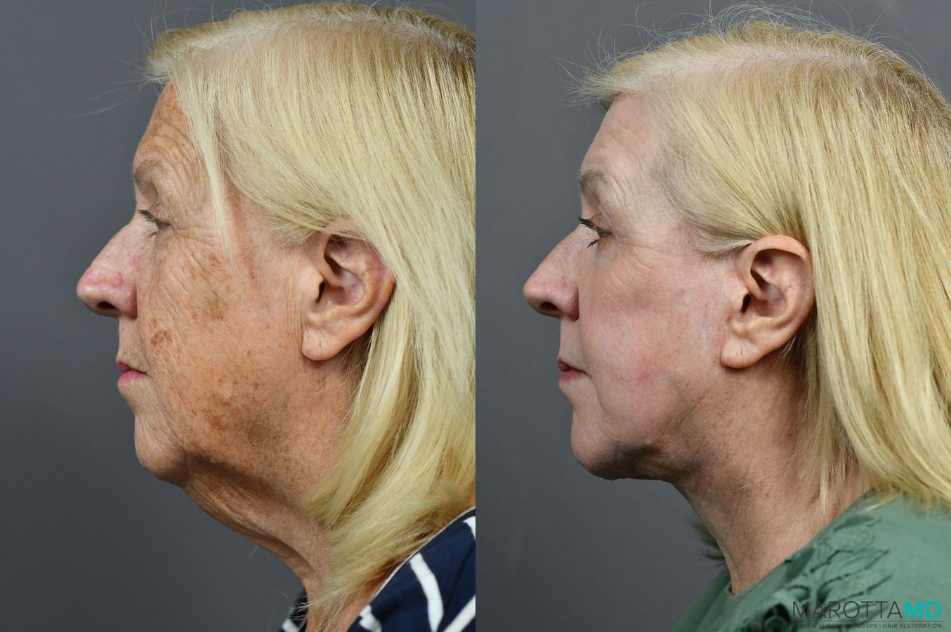 Before and after Laser Skin Resurfacing - Face case 7021 - Angle 3