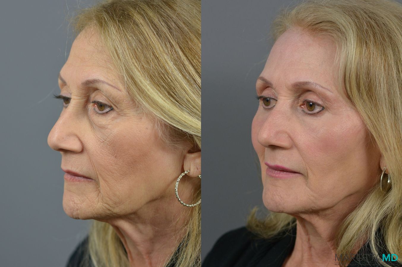 Before and after Laser Skin Resurfacing - Face case 6992 - Angle 2