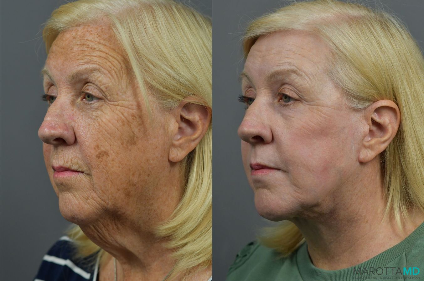 Before and after Laser Skin Resurfacing - Face case 7021 - Angle 2