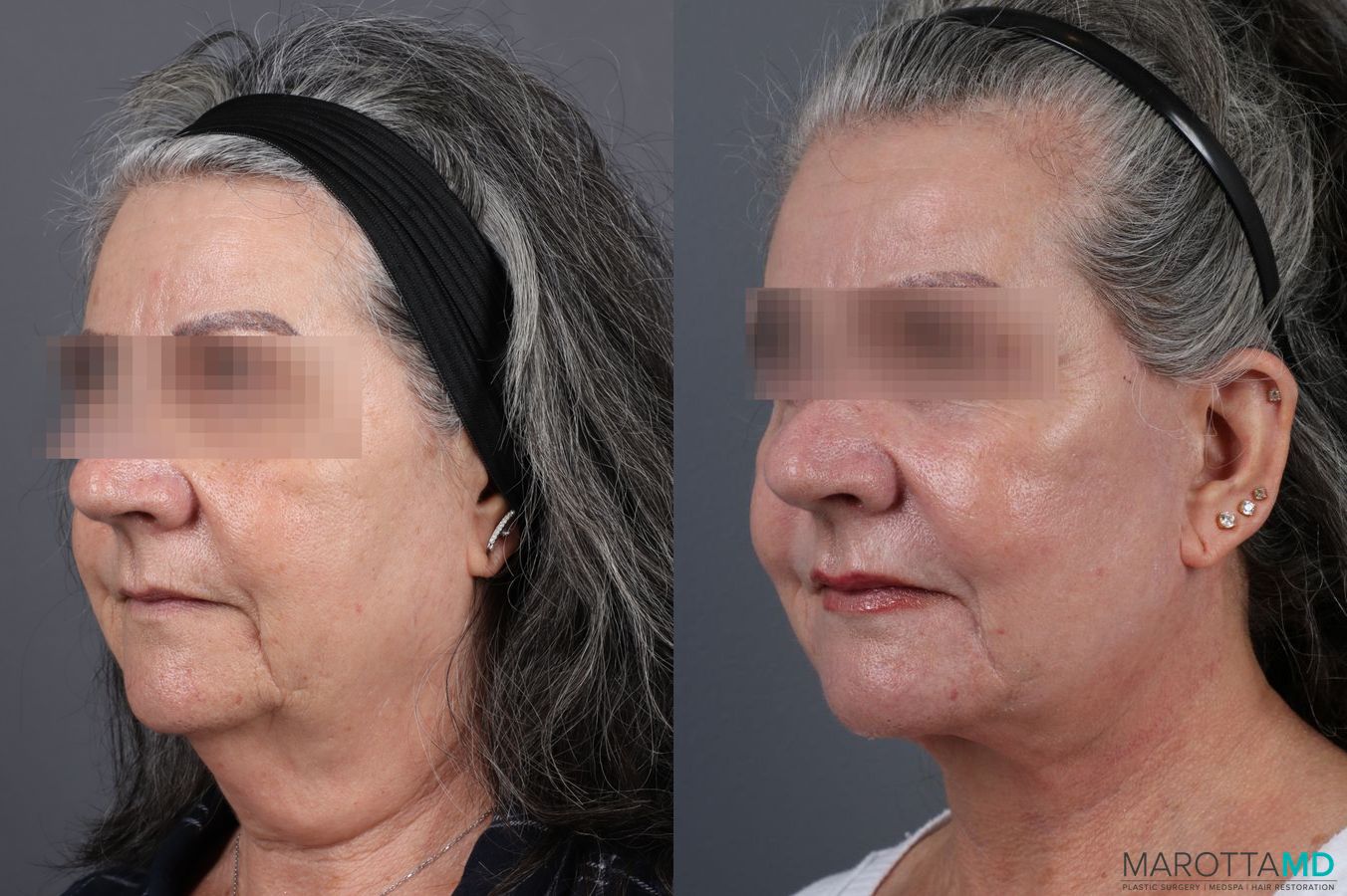 Before and after Laser Skin Resurfacing - Face case 7310 - Angle 2